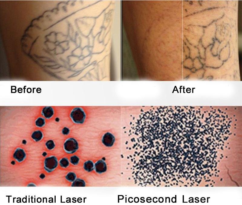 Tattoo removal