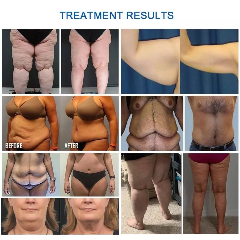 360 cryo treatment results