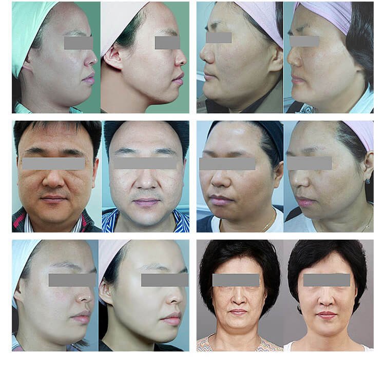 7d_hifu_before_and_after (4)