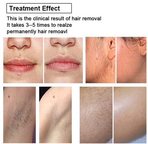 Soprano Titanium Diode Laser Hair Removal System effects