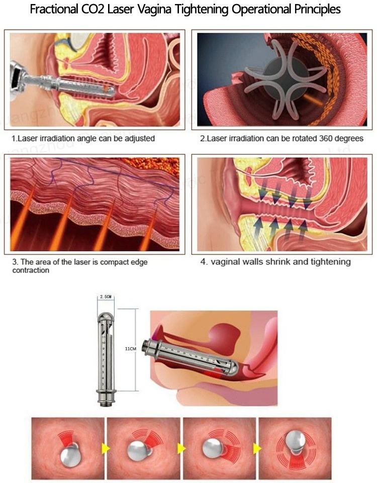 vaginal treatment of co2 fractional laser