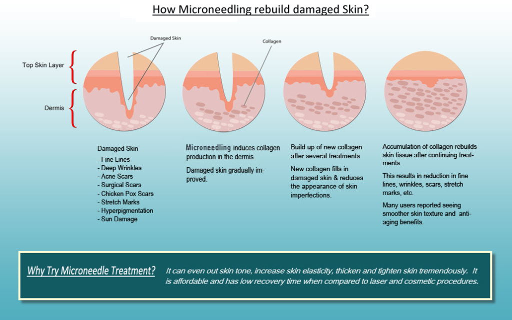 how microneedling rebuild damaged skin