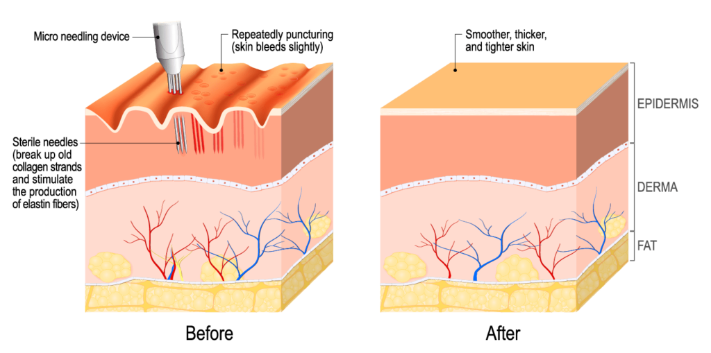 How does microneedling work?