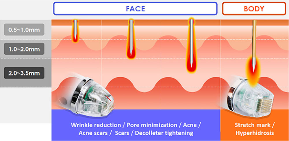 fractional rf gold microneedling depth