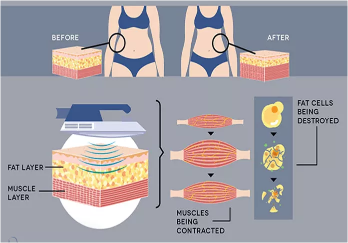 EMS Sculpting Technology