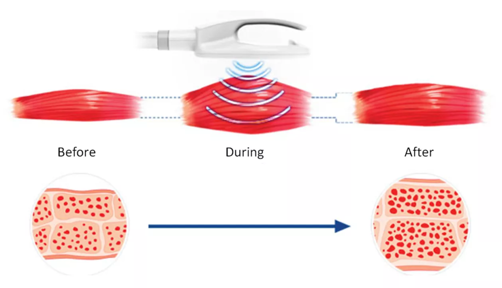 How does HIEMT technology work