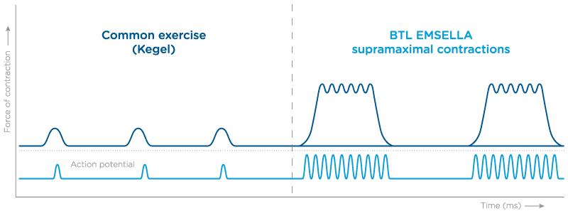 Common kegel exerciese vs EMSELLA