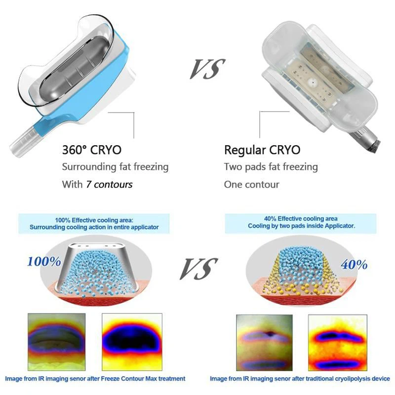 360 cryo vs common cryolipolysis