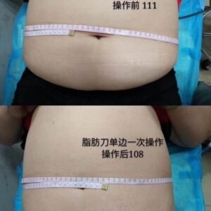Exilis Monopolar RF Face Skin Rejuvenation 2 IN 1 RF Body Contouring Cellulite Reduction Face Lifting Machine - Image 9