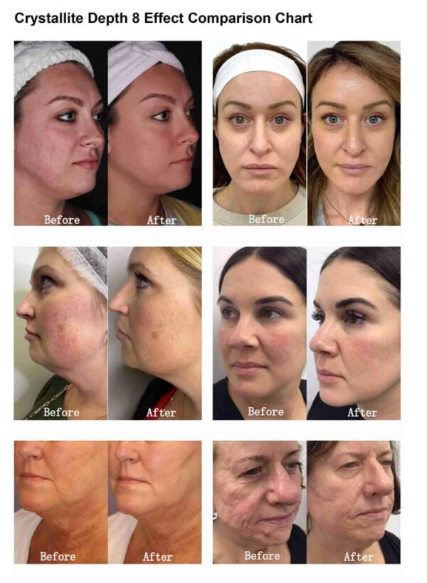 Morpheus8 Pro Max before and after