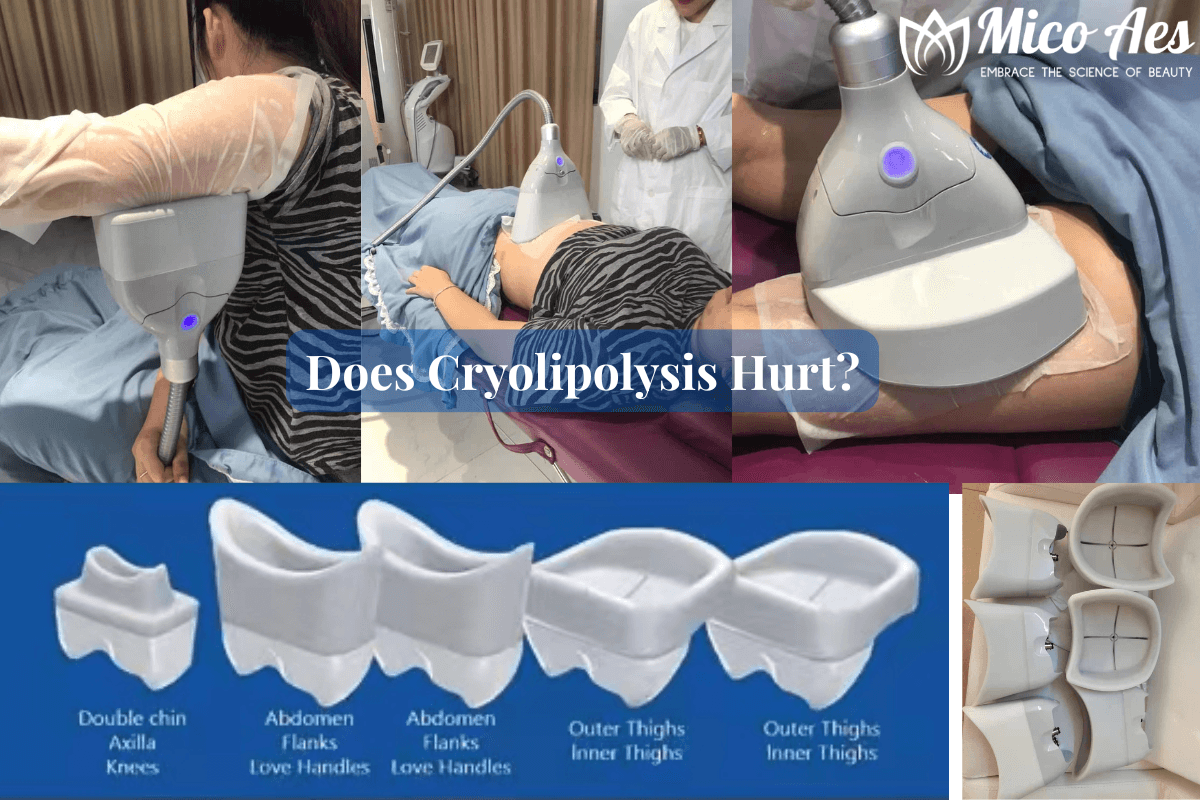 Does-Cryolipolysis-Hurt