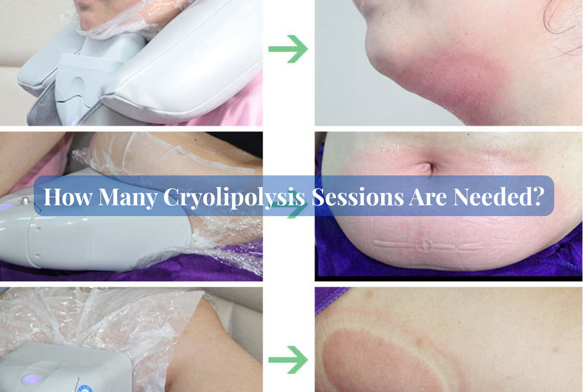 How-Many-Cryolipolysis-Sessions-Are-Needed