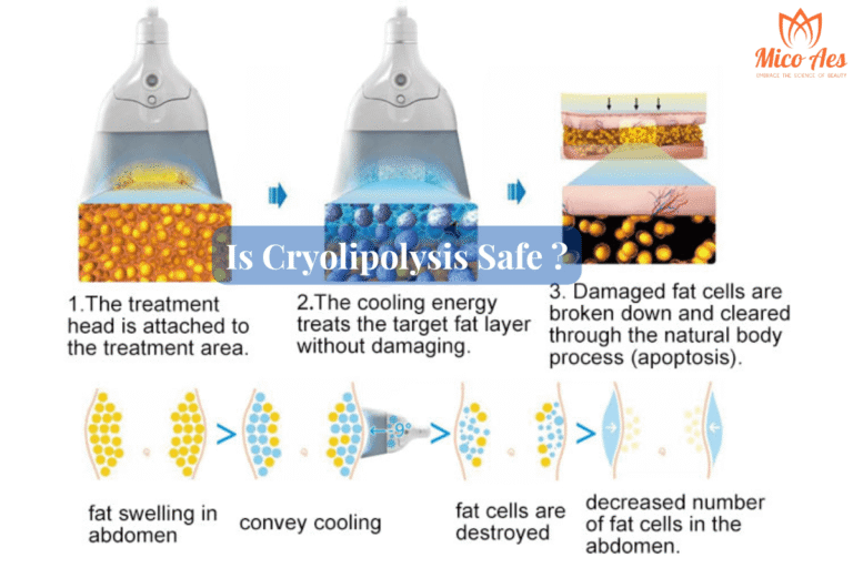 is cryolipolysis safe (1)